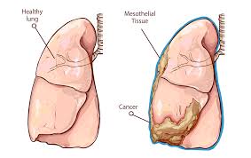 Asbestos, Mesothelioma, Lung Cancer